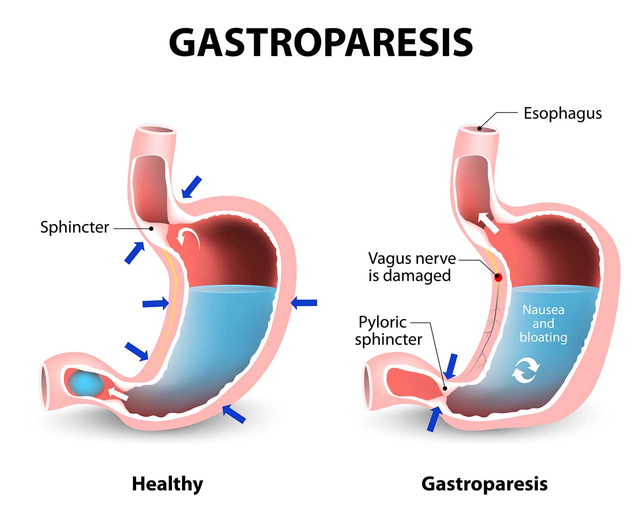 Effective Ways to Optimize Your Gastroparesis Diet for Better Digestion in 2025